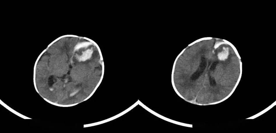 超研股份：超声在颅脑应用已获多项专利
