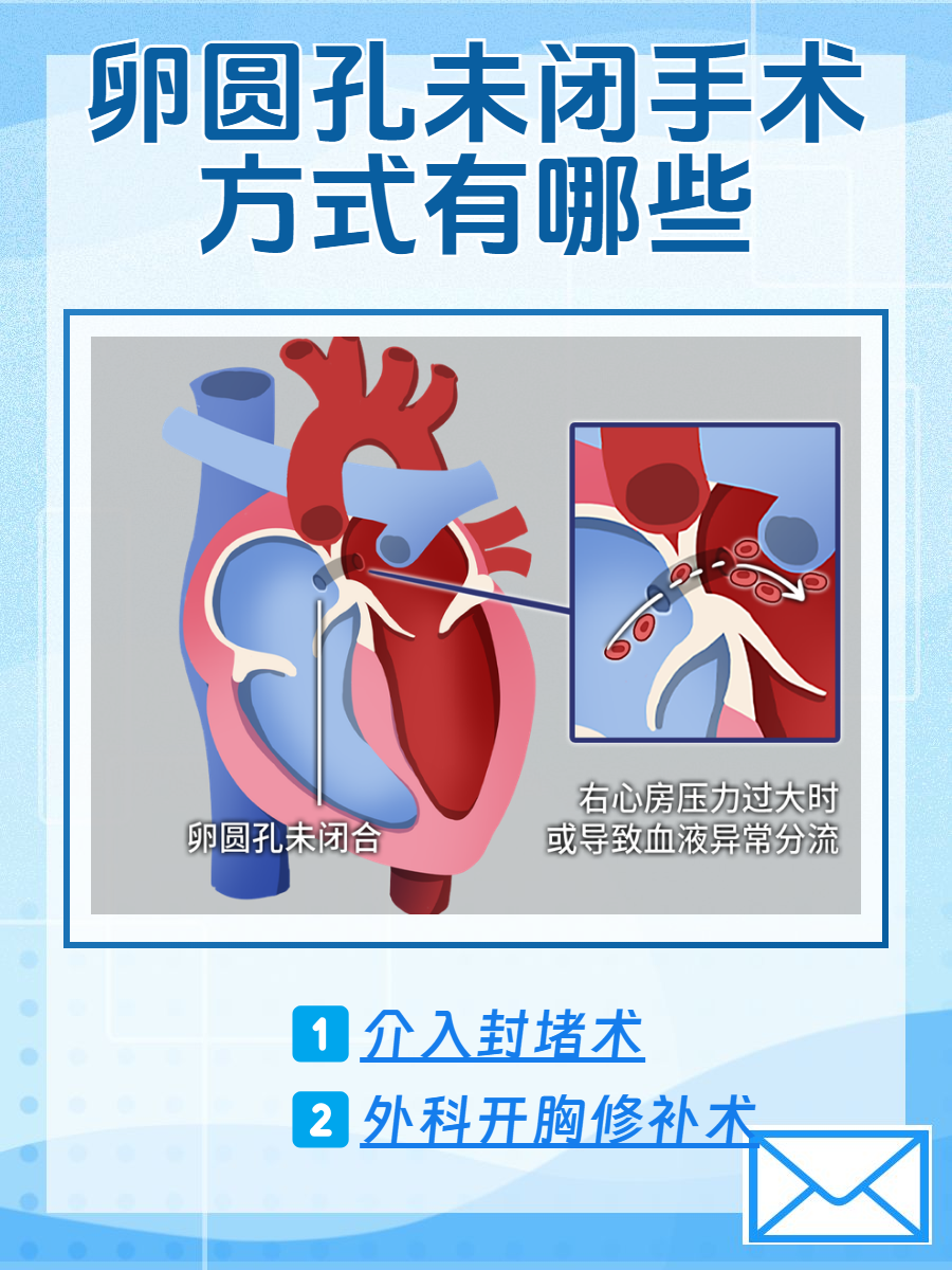 我国科研团队研发新技术开创“流体封堵”心脏介入治疗范式